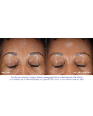 Extra Strength Active Peel Brightening System